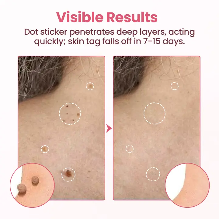 Painless Micro Wart Removal Patch - Image 7