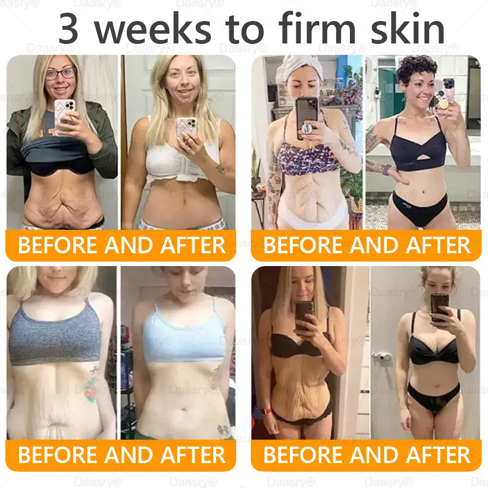 Bee Venom Treatment Cream with bee venom peptides, botulinum toxin, hyaluronic acid, and collagen. Targets wrinkles, fine lines, sagging, stretch marks, dark spotsfirming, lifting and more - Image 4