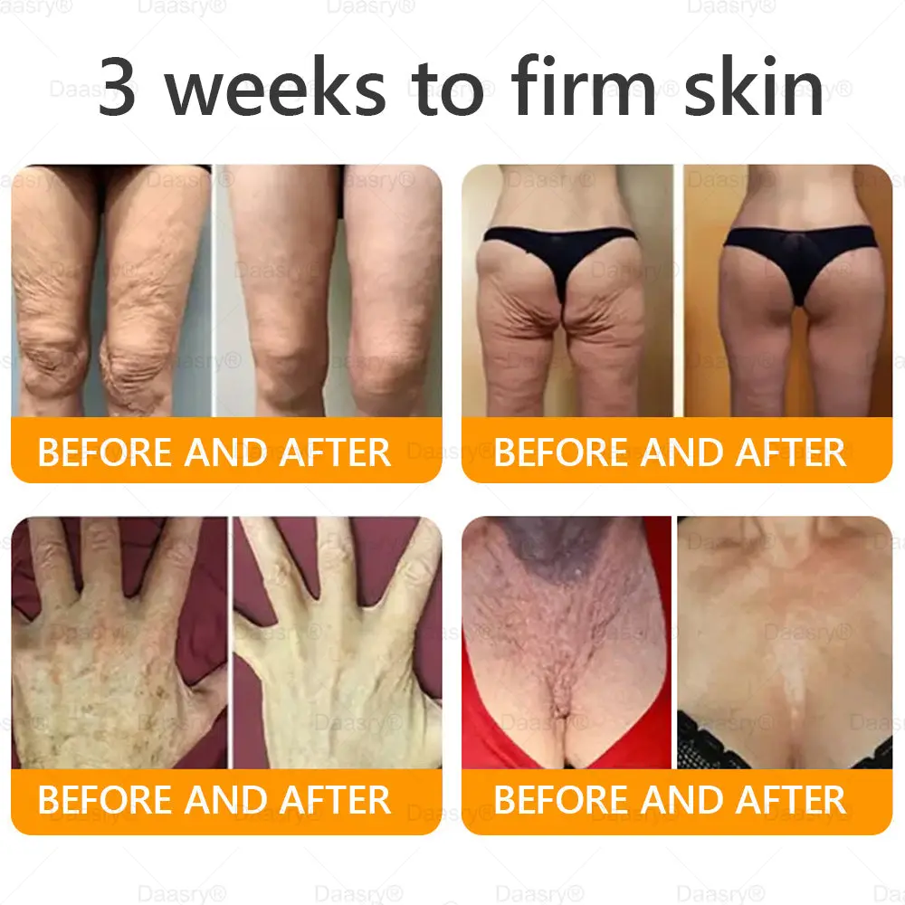 Bee Venom Treatment Cream with bee venom peptides, botulinum toxin, hyaluronic acid, and collagen. Targets wrinkles, fine lines, sagging, stretch marks, dark spotsfirming, lifting and more - Image 5