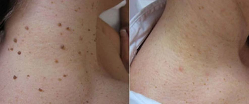 non-invasive laser pointer - mole and wart removal - Image 7