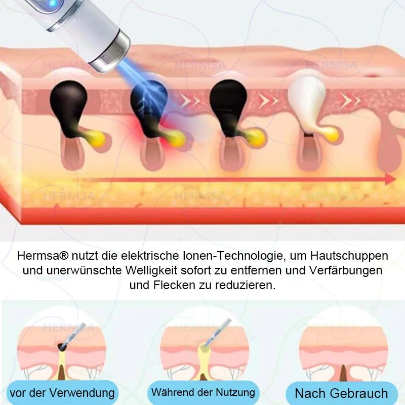 non-invasive laser pointer - mole and wart removal - Image 14