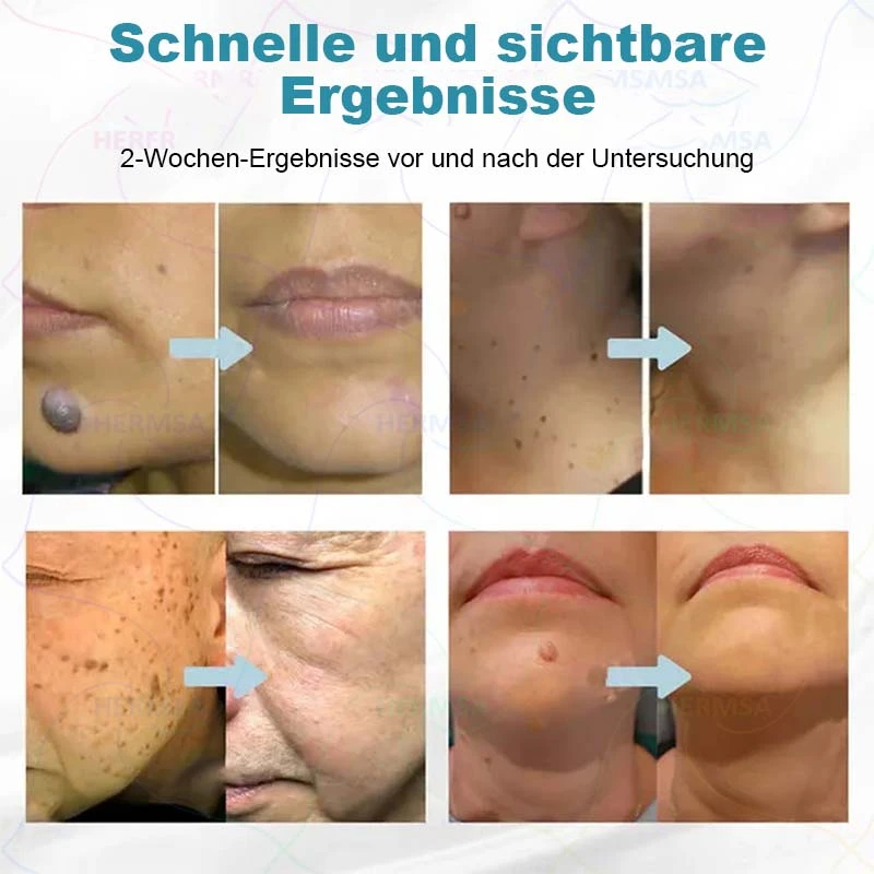 non-invasive laser pointer - mole and wart removal - Image 15