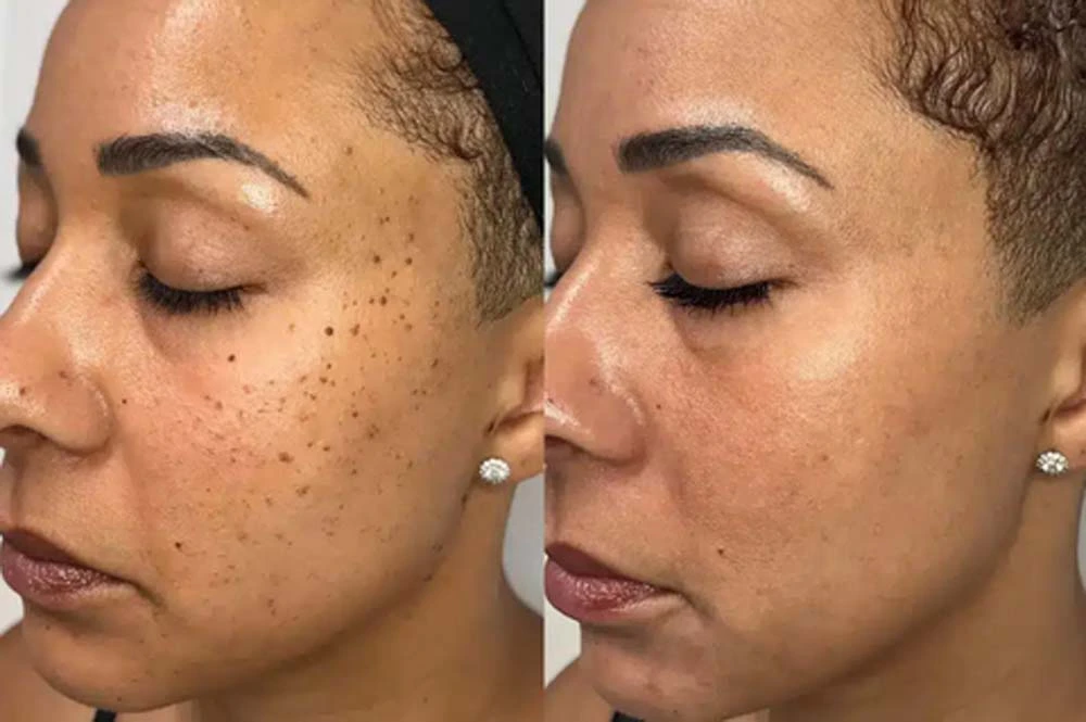 non-invasive laser pointer - mole and wart removal - Image 5