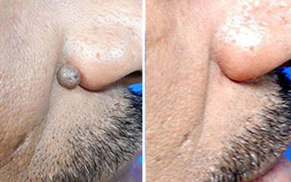 non-invasive laser pointer - mole and wart removal - Image 6