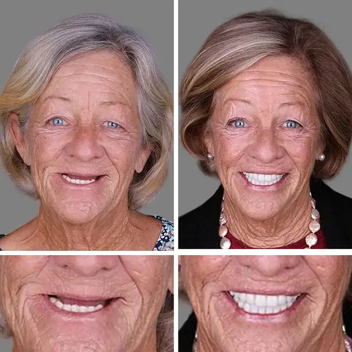 --Advanced Customized Full Denture Set - Image 9