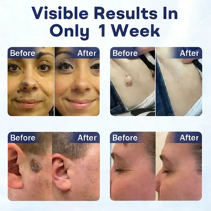 Mole and Wart Removal Cream - Image 2