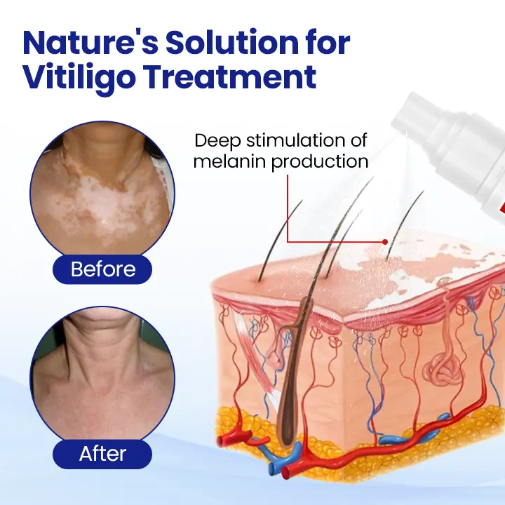 Vitiligo Treatment Spray Visible Results in Weeks, 100 Natural Steroid-Free - Image 3