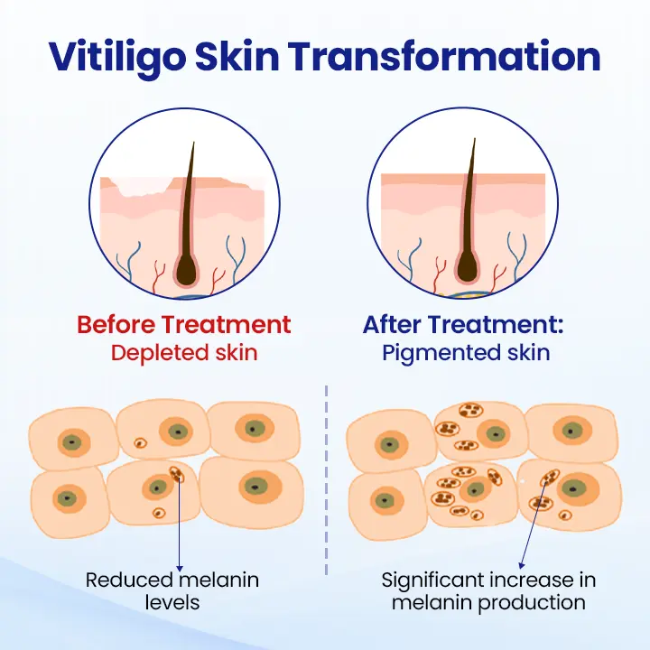Vitiligo Treatment Spray Visible Results in Weeks, 100 Natural Steroid-Free - Image 4