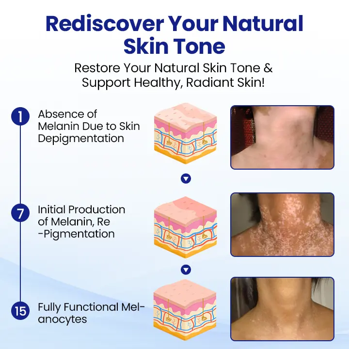 Vitiligo Treatment Spray Visible Results in Weeks, 100 Natural Steroid-Free - Image 5