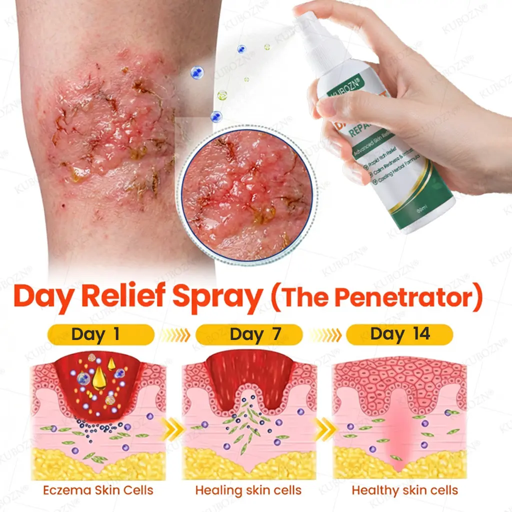 Eczema Day & Night Repair System - 100% Steroid-Free Relief Duo for Intense Itch, Redness & Broken Skin - Image 2