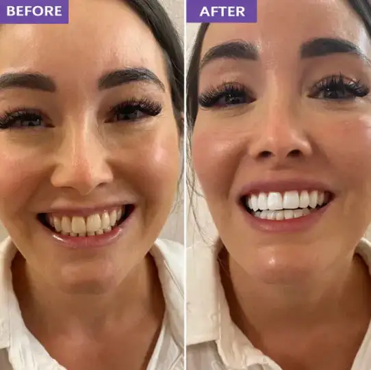 Novora Purple Teeth Whitening Strips - Image 11