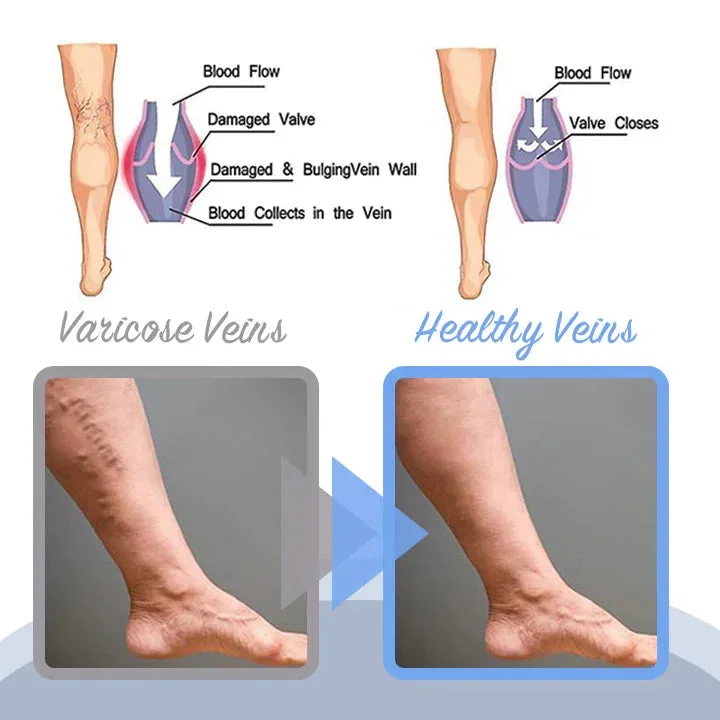 Sale Varicose Veins Relief Spray - Image 3
